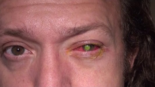 Chad Groeschen was working on an outdoor deck for a client a few weeks ago when his left eye started ... Chad Groeschen was working on an outdoor deck for a client a few weeks ago when his left eye started ...