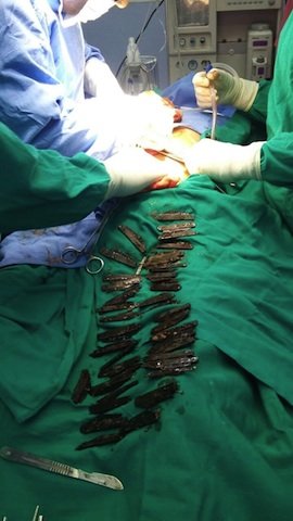 A man in India spent two months swallowing knives and had 40 of them surgically removed from his stomach, according ... A man in India spent two months swallowing knives and had 40 of them surgically removed from his stomach, according ...