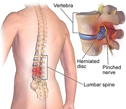 Only about 5 percent of cases of low back pain require surgery. The majority of cases can be treated with ... Only about 5 percent of cases of low back pain require surgery. The majority of cases can be treated with ...