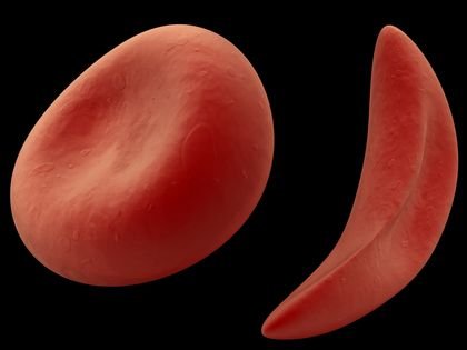 Sickle Cell Disease Patients Are Less Likely To Follow Physician