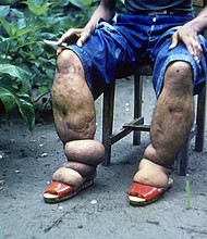 Elephantiasis of leg due to filariasis.