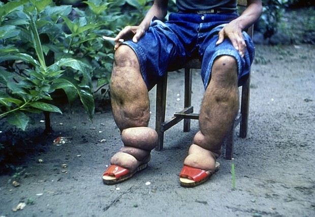 Elephantiasis of leg due to filariasis.