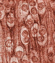 This is a photomicrograph depicting numbers of Trichinella spiralis cysts seen embedded in a muscle tissue specimen, in a case of trichinellosis, which was acquired by ingesting meat containing cysts (encysted larvae) of Trichinella sp. roundworm (nematode) parasites.