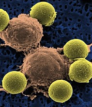 A new gene therapy drug, the first in its class, was recommended for approval to the US Food and Drug Administration by an advisory committee on Wednesday, July 12, 2017. If approved by the FDA, the drug will be a new avenue for some leukemia patients whose first-line drugs have failed.