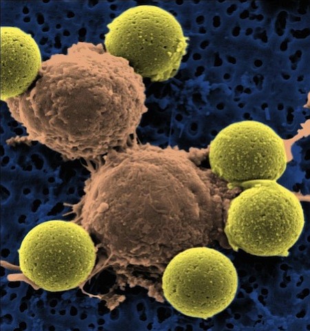 A new gene therapy drug, the first in its class, was recommended for approval to the US Food and Drug Administration by an advisory committee on Wednesday, July 12, 2017. If approved by the FDA, the drug will be a new avenue for some leukemia patients whose first-line drugs have failed.