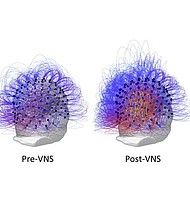 Credit: Marc Jeannerod/Institut des Sciences Cognitives  EEG images show an increase of information sharing across the brain, as evidenced by the yellow and orange colors, following vagus nerve stimulation.