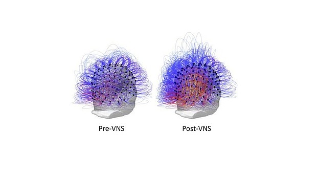 Credit: Marc Jeannerod/Institut des Sciences Cognitives  EEG images show an increase of information sharing across the brain, as evidenced by the yellow and orange colors, following vagus nerve stimulation.