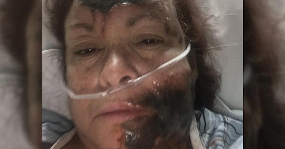 Lizzie Dunn, a 52-year-old white woman from Staten Island, suffers from second-degree burns after fabricating a story that a black …