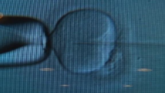 An Ohio fertility clinic says more than 4,000 eggs and embryos were affected by a freezer malfunction, double the number previously thought -- and that it's unlikely any of them are viable.