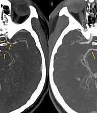 What happened to a contestant in a hot-pepper-eating contest may give spicy food aficionados one more reason to "fear the reaper," according to a recent case report.
