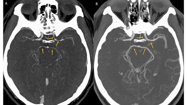 What happened to a contestant in a hot-pepper-eating contest may give spicy food aficionados one more reason to "fear the reaper," according to a recent case report.