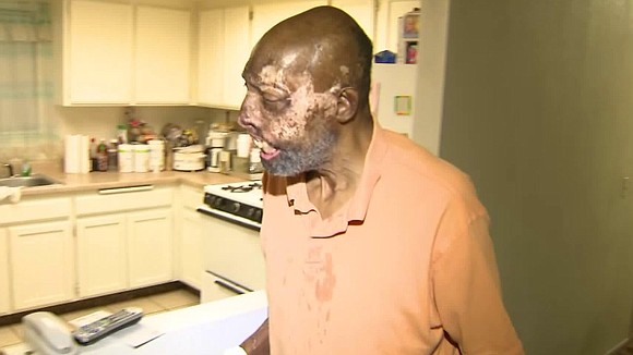 A Los Angeles man who suffered extensive burns in a crash told KTLA on Friday that he was raising money …
