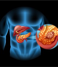 Pancreatic cancer is the third-leading cause of death from cancer in the United States, after lung and colorectal cancers