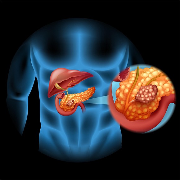 Pancreatic cancer is the third-leading cause of death from cancer in the United States, after lung and colorectal cancers