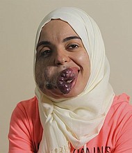 Lamise ElBetar, who is from Egypt, was born with a venous malformation, a mass of intertwined veins and muscle that has been growing since she was born.