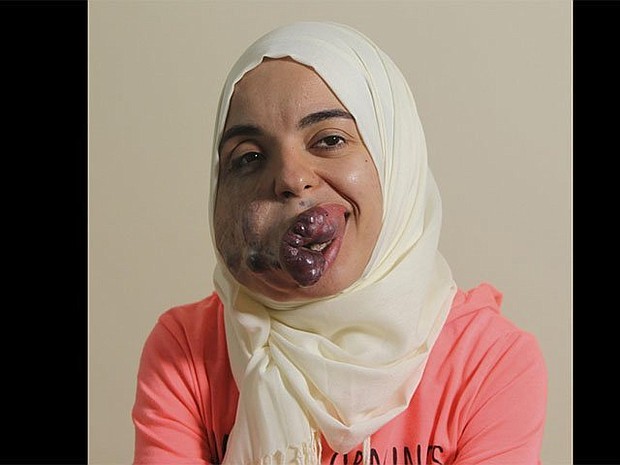 Lamise ElBetar, who is from Egypt, was born with a venous malformation, a mass of intertwined veins and muscle that has been growing since she was born.