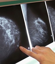 A new study says older women with excess body fat, even if they have a normal body-mass index, could be at a greater risk for breast cancer.
