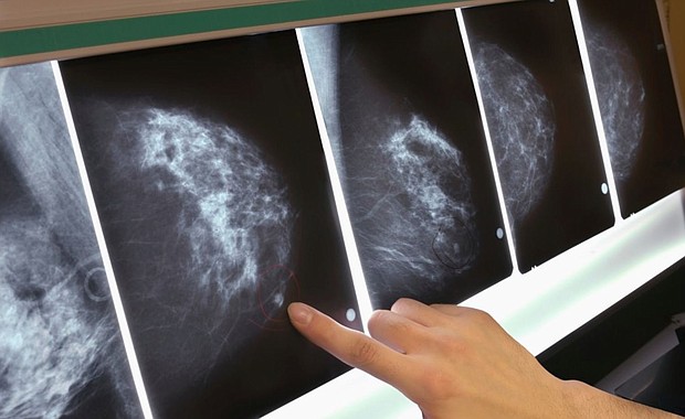 A new study says older women with excess body fat, even if they have a normal body-mass index, could be at a greater risk for breast cancer.