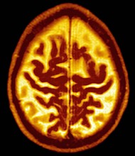 Late Onset Alzheimer's Disease Senile Dementia. Symmetric Enlargement Of Cerebral Sulci Suggests That Cortical Gray Matter Is Affected.