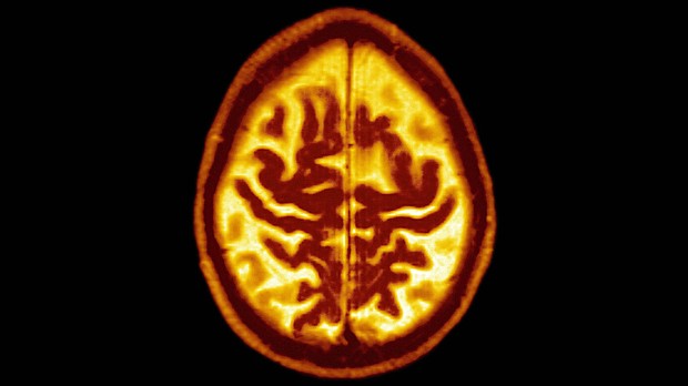 Late Onset Alzheimer's Disease Senile Dementia. Symmetric Enlargement Of Cerebral Sulci Suggests That Cortical Gray Matter Is Affected.