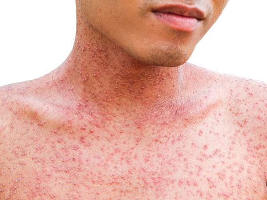 Measles Outbreak Causes Concern For Parents Our Weekly Black News And Entertainment Los Angeles