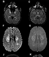 Brain scans from the University College London study, published on July 8./Credit:	University College London
