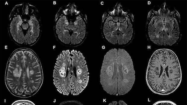 Brain scans from the University College London study, published on July 8./Credit:	University College London
