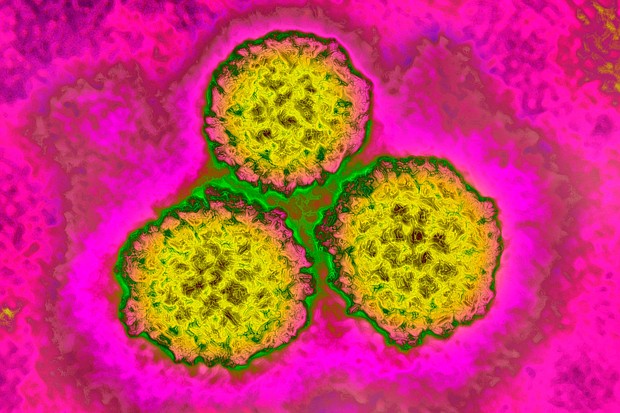 The first generation Human papillomavirus (HPV) vaccine cut cervical cancer rates among women by 87%, British researchers reported.
Mandatory Credit:	BSIP/Universal Images Group/Getty Images