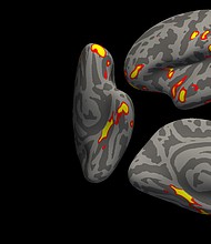 The red-yellow regions are the parts of the brain that shrink the most in the 401 SARS- CoV-2 infected participants, compared with the 384 non-infected participants. These areas are related to the sense of smell, and include the parahippocampal gyrus, the orbitofrontal cortex and the insula. We present the results in half of the brain (the left hemisphere, with inferior, side and medial views), on an average brain that has been "inflated" to show the nooks and crannies of the brain.
Mandatory Credit:	G. Douaud, in collaboration with Anderson Winkler and Saad Jbabdi, University of Oxford and NIH.