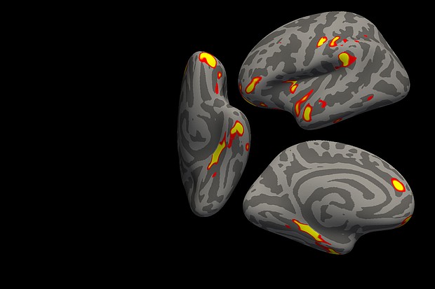 The red-yellow regions are the parts of the brain that shrink the most in the 401 SARS- CoV-2 infected participants, compared with the 384 non-infected participants. These areas are related to the sense of smell, and include the parahippocampal gyrus, the orbitofrontal cortex and the insula. We present the results in half of the brain (the left hemisphere, with inferior, side and medial views), on an average brain that has been "inflated" to show the nooks and crannies of the brain.
Mandatory Credit:	G. Douaud, in collaboration with Anderson Winkler and Saad Jbabdi, University of Oxford and NIH.