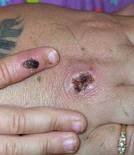 Symptoms of monkeypox virus may include unusual rashes or lesions. The US Centers for Disease Control and Prevention is collaborating with Massachusetts health officials on an investigation into a case of monkeypox, the agency said in a statement, May 18.
Mandatory Credit:	Getty Images North America/Getty Images