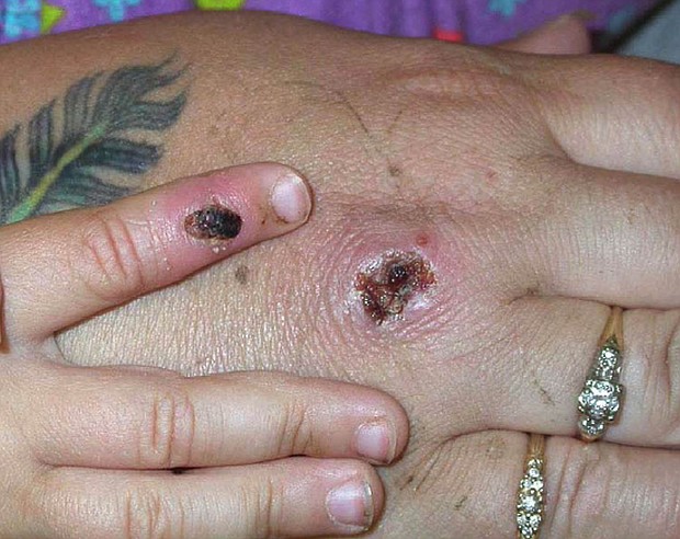 Symptoms of monkeypox virus may include unusual rashes or lesions. The US Centers for Disease Control and Prevention is collaborating with Massachusetts health officials on an investigation into a case of monkeypox, the agency said in a statement, May 18.
Mandatory Credit:	Getty Images North America/Getty Images