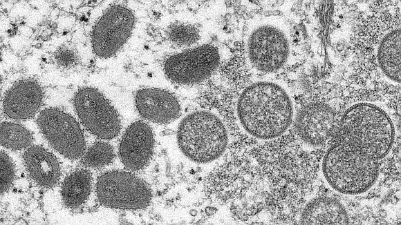 The United States is responding to a request for the release of monkeypox vaccine from the nation's Strategic National Stockpile ...