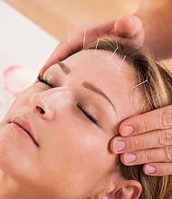 People who have chronic tension headaches could find sustained relief with the help of acupuncture treatments.
Mandatory Credit:	Adobe Stock