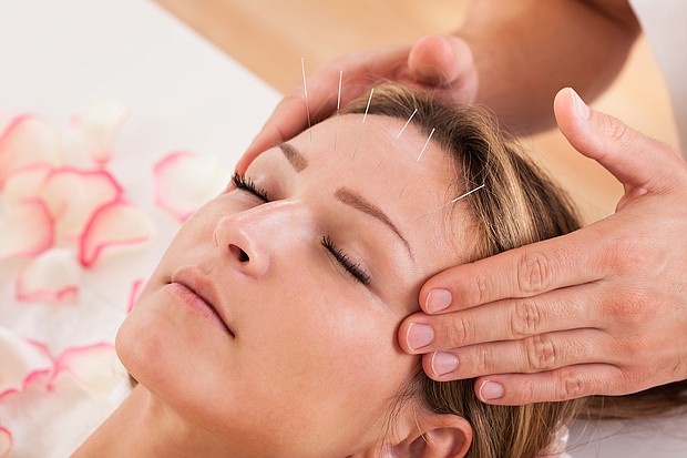 People who have chronic tension headaches could find sustained relief with the help of acupuncture treatments.
Mandatory Credit:	Adobe Stock