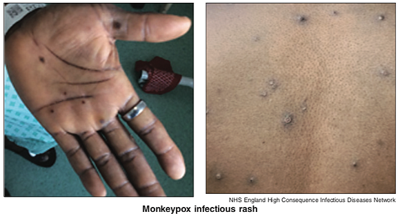 In response to the spread of the monkeypox virus, the Richmond and Henrico health districts are vaccinating people who may …