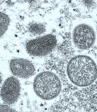 A drug is available for monkeypox patients who have or who are at risk of severe disease, but doctors say they continue to face challenges getting access to it.
Mandatory Credit:	CNN