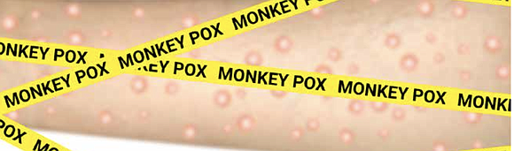 The Texas Department of State Health Services has confirmed the first death of a person diagnosed with monkeypox in Texas. …