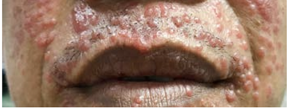 The lesions, known as Mollusca, are small, raised, and usually white, pink, or flesh-colored with a dimple or pit in … The lesions, known as Mollusca, are small, raised, and usually white, pink, or flesh-colored with a dimple or pit in …