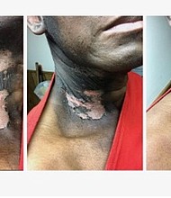 Caption: After applying Moore Relief Revitalizing & Burn Lotion to this patient’s untreated radiation-burn scars (left), rapid healing was visible after two days (center) and after two weeks (right).
