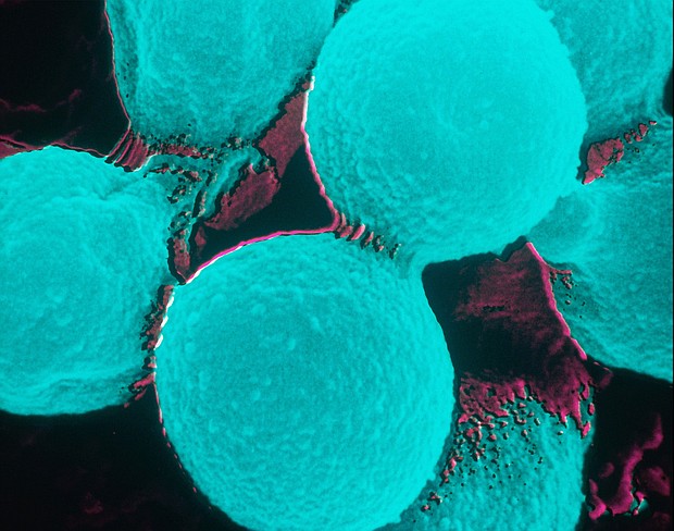 Most people exposed to cryptococcus neoformans won't get sick, but some do.
Mandatory Credit:	BSIP/Universal Images/Getty Images
Dateline:	File