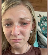 This photo of Gabby Petito showing facial injuries was released by the law office representing her family in a suit against the Moab City Police Department.
Mandatory Credit:	Parker & McConkie