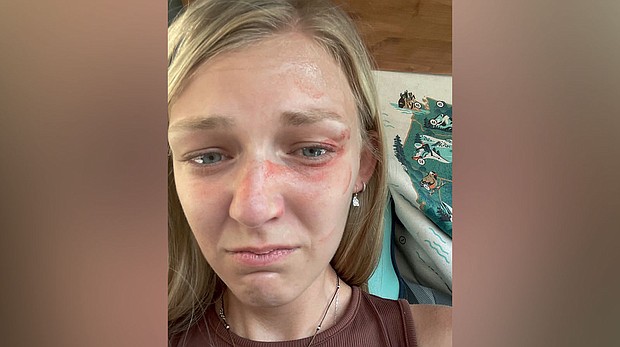 This photo of Gabby Petito showing facial injuries was released by the law office representing her family in a suit against the Moab City Police Department.
Mandatory Credit:	Parker & McConkie