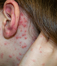 Natural vaccination. Contagious disease. Sick child with chickenpox. Varicella virus or Chickenpox bubble rash on child body and face. High quality photo