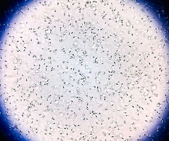 The sperm of a man carrying a rare genetic mutation linked to cancer was used to conceive scores of children …