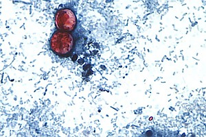 Cyclosporiasis outbreak