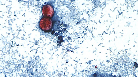 A rapidly growing cyclospora outbreak linked to recalled shredded iceberg lettuce has sickened thousands across multiple states, prompting health officials … A rapidly growing cyclospora outbreak linked to recalled shredded iceberg lettuce has sickened thousands across multiple states, prompting health officials …